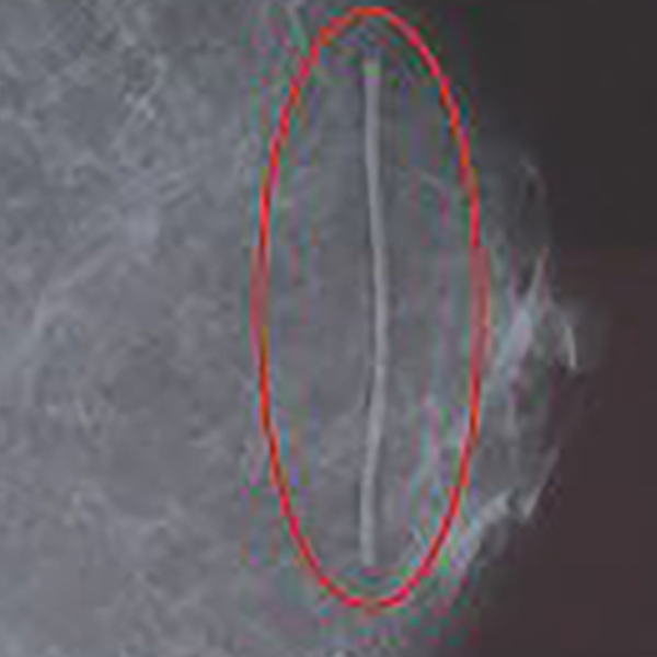 SPEE-D RADIOLOGY MARKER SKIN 1MM